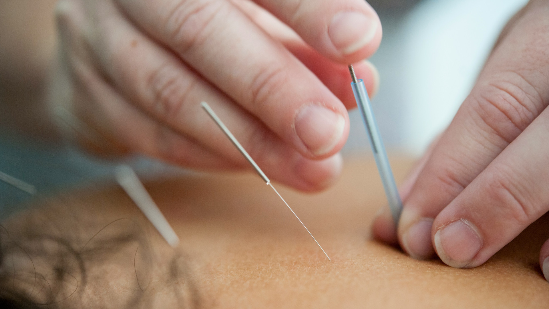Découvrez les bienfaits de l'acupuncture pour votre santé